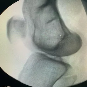 A UM FACULTY MEMBER PARTICIPATES IN PERFORMING A SUCCESSFUL SURGERY USING ILIZAROV APPARATUS LENGTHEN OR RESHAPE LIMB BONES